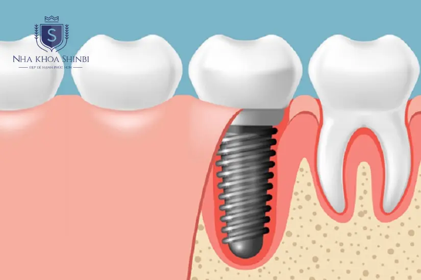 Chi phí cấy ghép răng khểnh hết bao nhiêu?