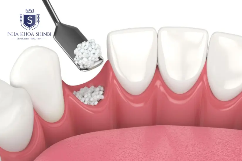 Kỹ thuật cấy ghép xương ổ răng là như thế nào?