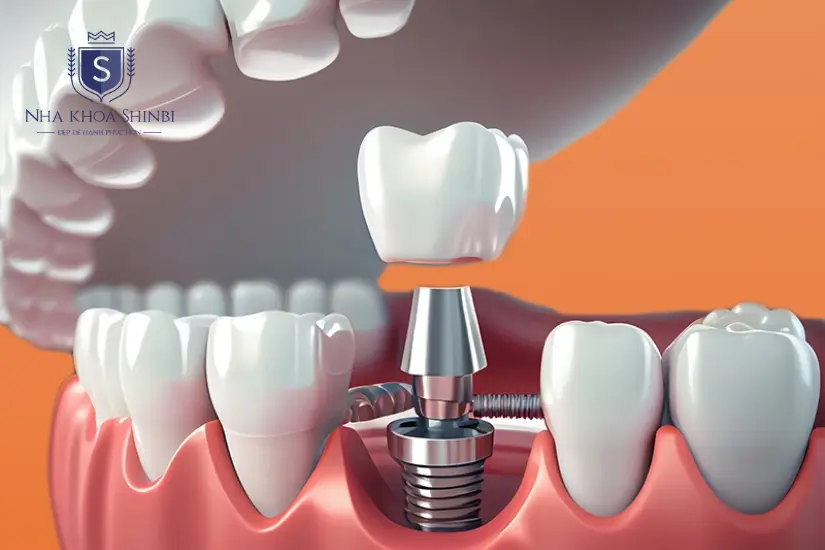 Trồng răng implant