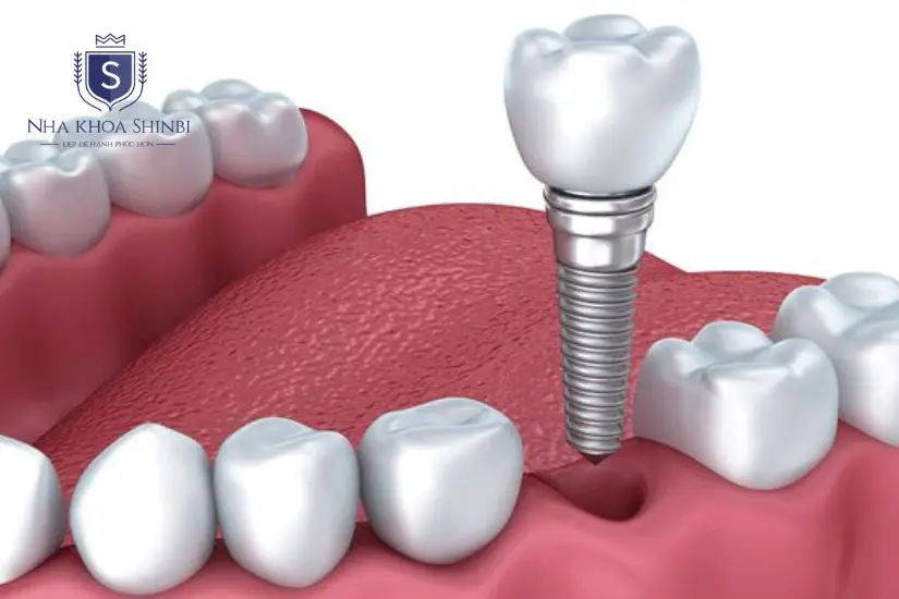 Trồng răng implant Trồng răng implant