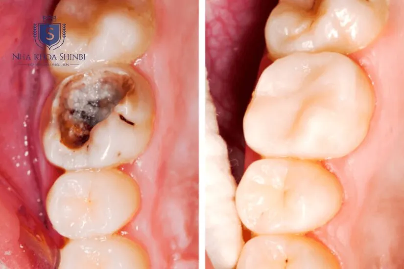 Bọc răng sứ khi răng sâu giai đoạn nặng Bọc răng sứ khi răng sâu giai đoạn nặng