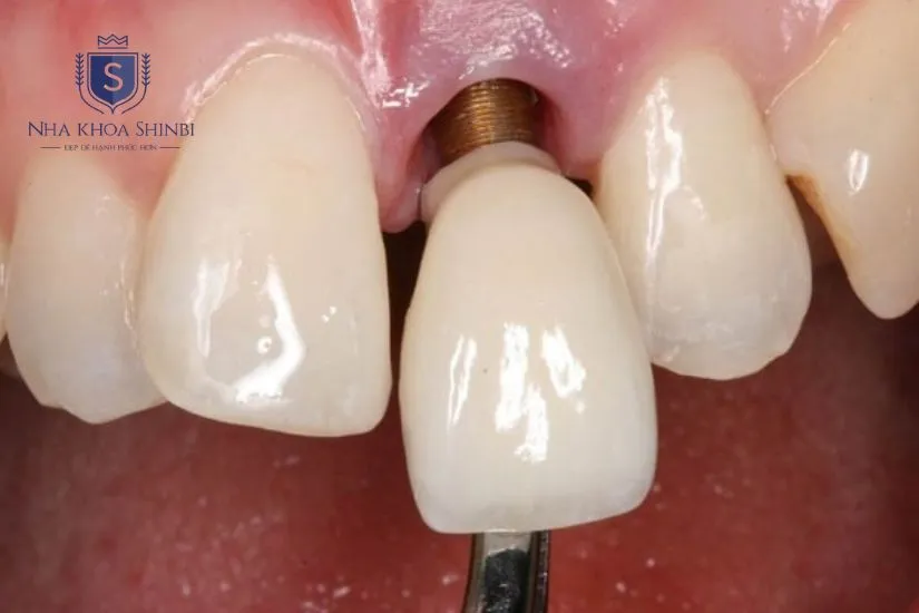 Cấy ghép implant răng cửa có an toàn không?