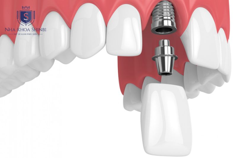 Chi phí mão sứ vùng răng cửa và răng nanh thường cao hơn răng hàm