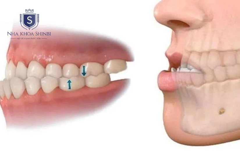 Trường hợp không nên bọc răng sứ Trường hợp không nên bọc răng sứ