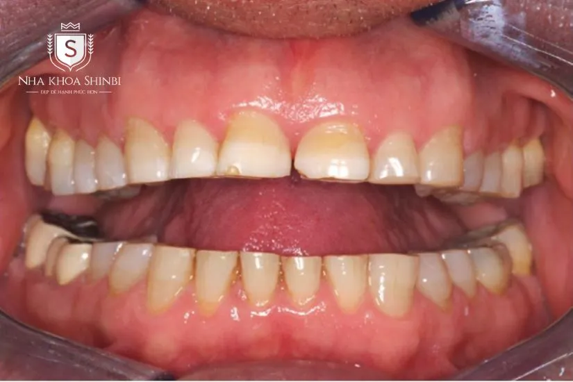Các trường hợp bắt buộc phải bọc răng sứ Các trường hợp bắt buộc phải bọc răng sứ
