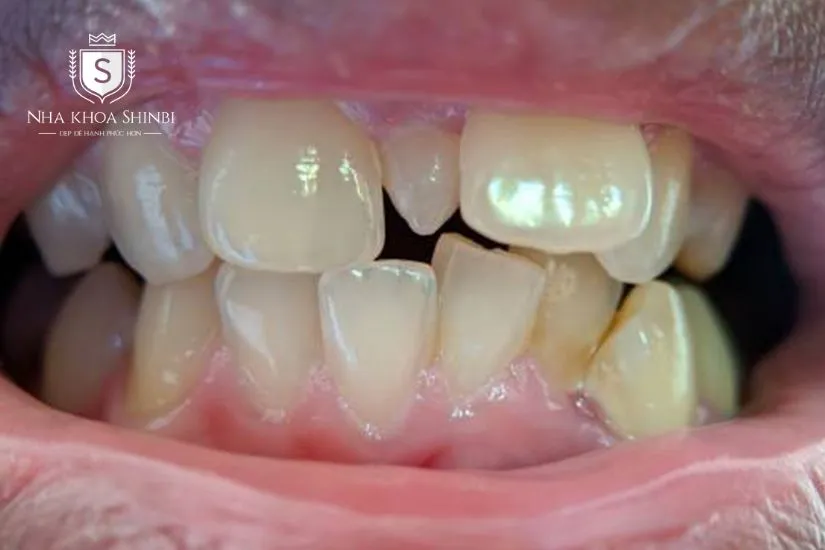 Trường hợp không nên bọc răng sứ