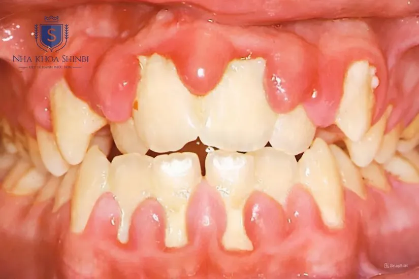 Trường hợp không nên bọc răng sứ Trường hợp không nên bọc răng sứ