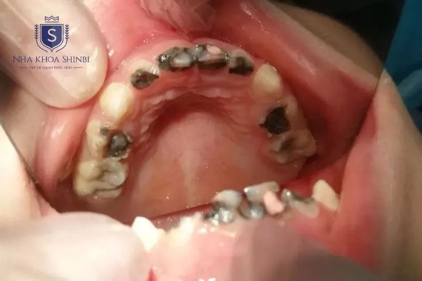 Trường hợp không nên bọc răng sứ Trường hợp không nên bọc răng sứ