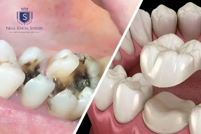 Các trường hợp bắt buộc phải bọc răng sứ Các trường hợp bắt buộc phải bọc răng sứ