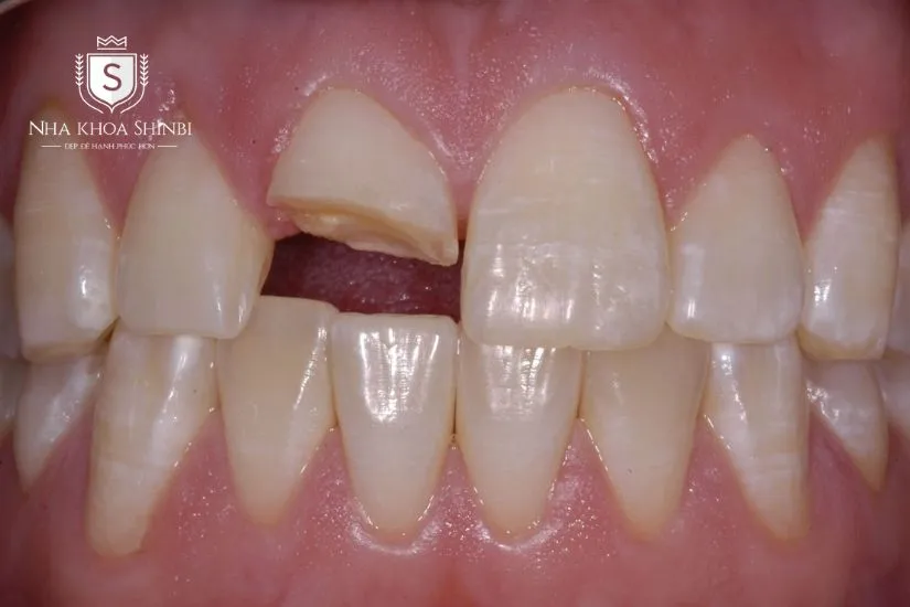 Các trường hợp bắt buộc phải bọc răng sứ Các trường hợp bắt buộc phải bọc răng sứ