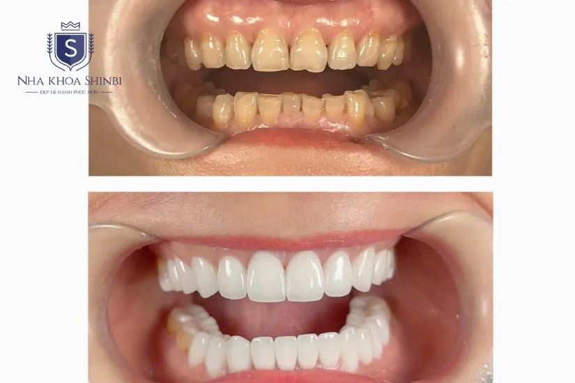 Các trường hợp bắt buộc phải bọc răng sứ Các trường hợp bắt buộc phải bọc răng sứ
