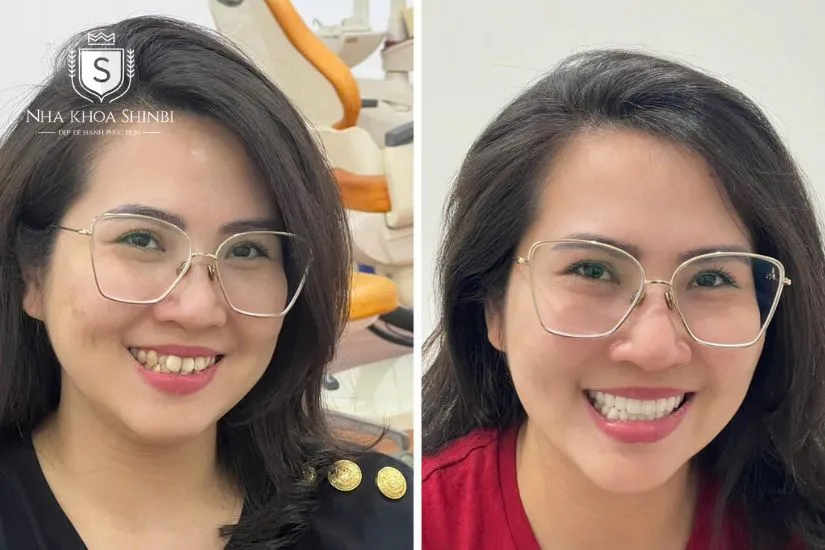 Các trường hợp bắt buộc phải bọc răng sứ Các trường hợp bắt buộc phải bọc răng sứ