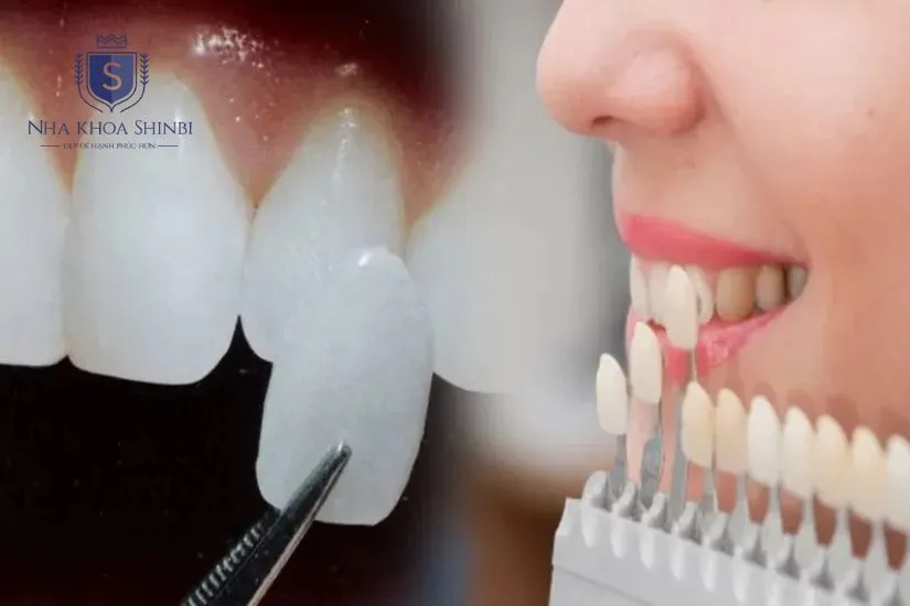 Dán răng sứ veneer có tốt không? Dán răng sứ veneer có tốt không?
