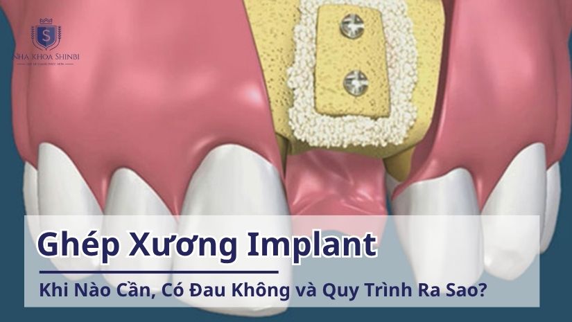 Ghép Xương Implant: Khi Nào Cần, Có Đau Không và Quy Trình Ra Sao?
