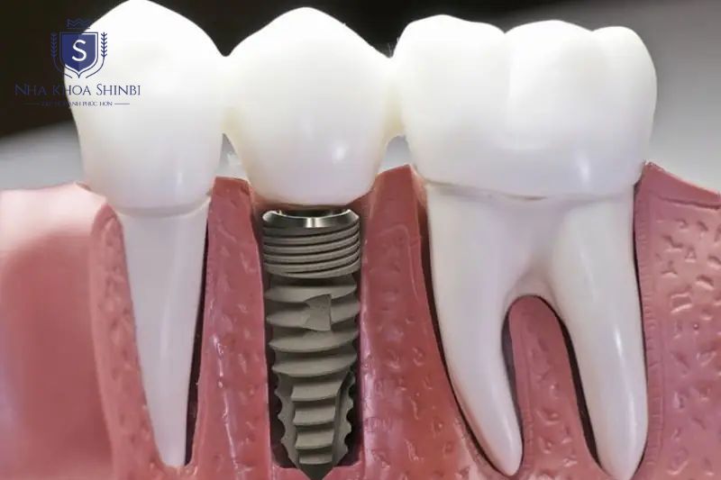 Implant chính hãng được đặt đúng kỹ thuật có tuổi thọ trung bình trên 20 năm