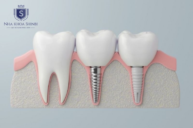 Implant đứng độc lập trong xương hàm nên không ảnh hưởng gì đến các răng kế cận