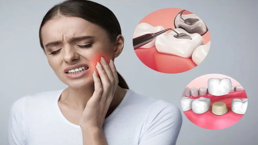 Nên trám răng hay bọc răng sứ? Phương pháp nào tối ưu nhất