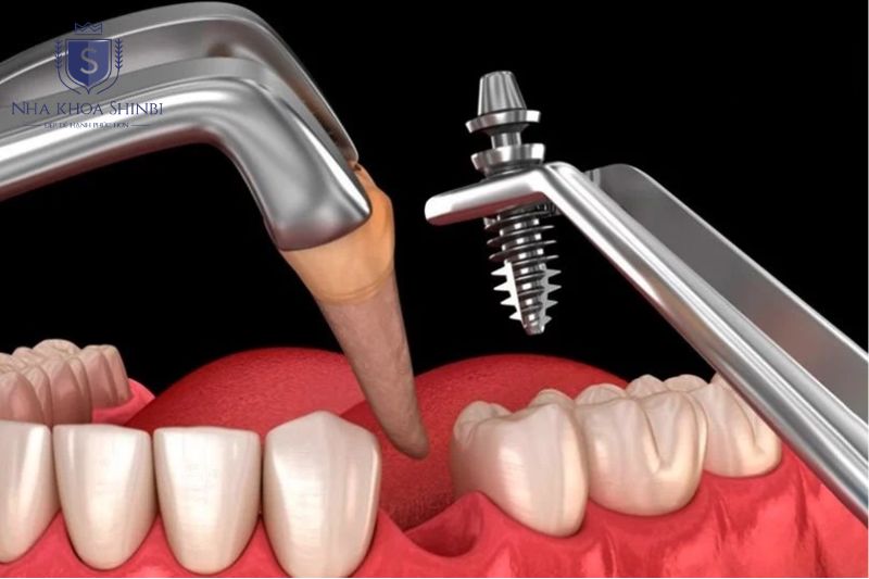 Phẫu thuật cấy trụ implant vào xương hàm là bước kỹ thuật trung tâm trong quy trình cấy ghép implant