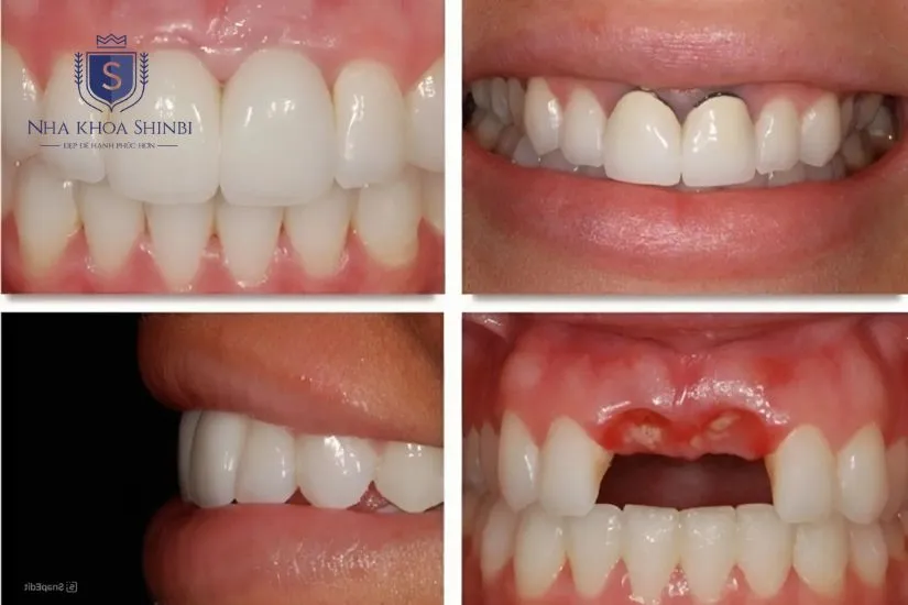 Phương pháp cấy ghép implant răng cửa là gì?