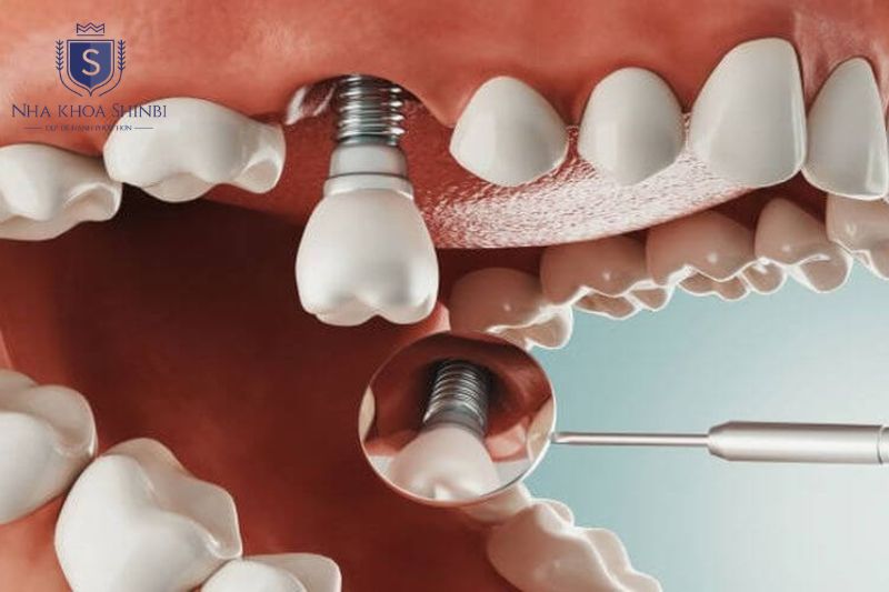 Quy trình làm răng implant mất khoảng 3 đến 4 tuần