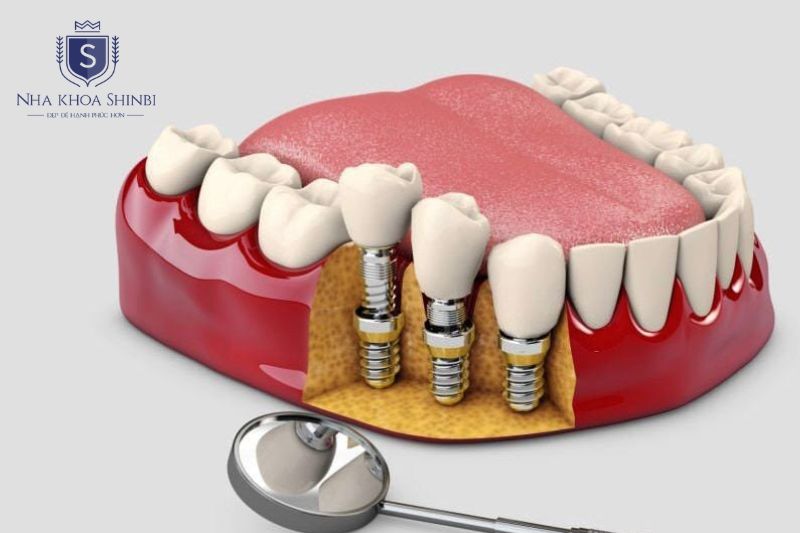 Quyết định trồng implant hay bọc sứ cho răng sâu nặng phụ thuộc vào mức độ tổn thương của răng