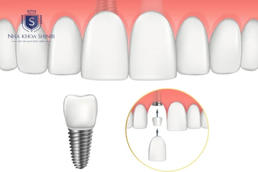 Thời gian cấy ghép implant răng cửa 