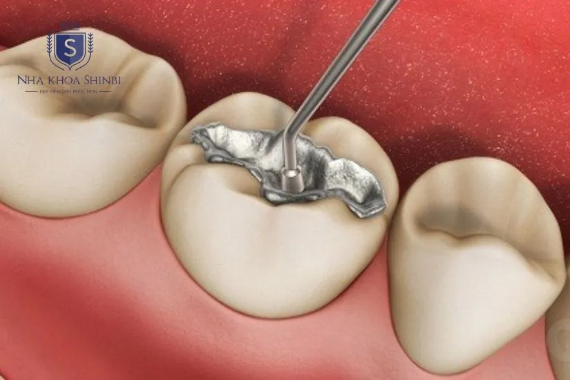 Trám răng khi răng sâu nhẹ Trám răng khi răng sâu nhẹ