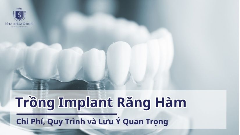 Trồng Implant Răng Hàm: Chi Phí, Quy Trình và Lưu Ý Quan Trọng