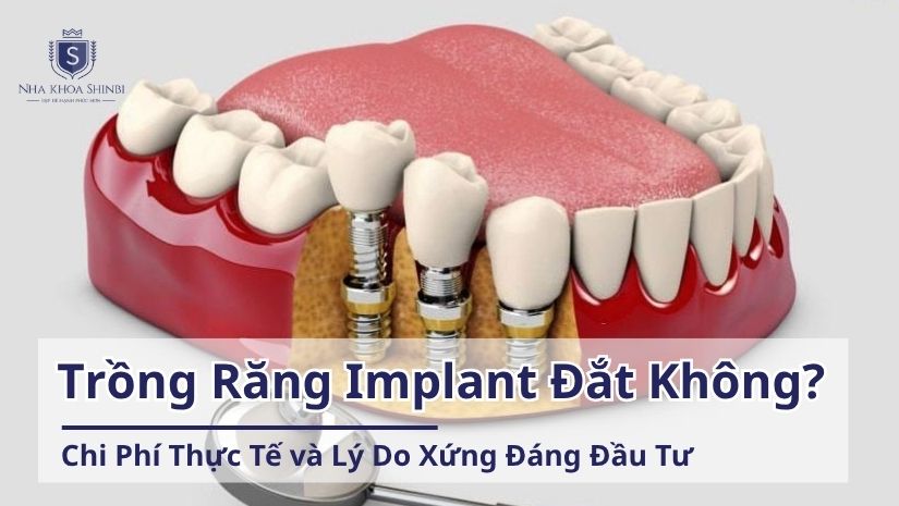 Trồng Răng Implant Có Đắt Không? Chi Phí Thực Tế và Lý Do Xứng Đáng Đầu Tư