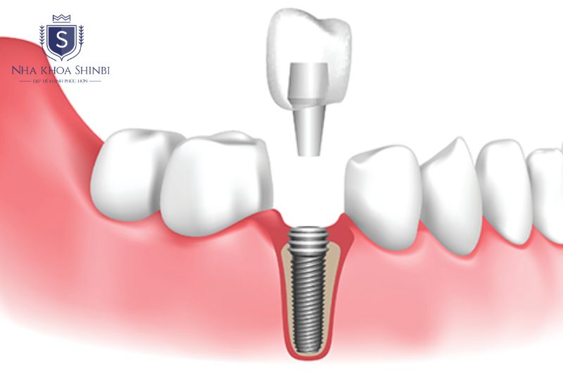 Trồng implant răng hàm chỉ định cho 8 chiếc răng hàm nhỏ và 8 chiếc răng hàm lớn