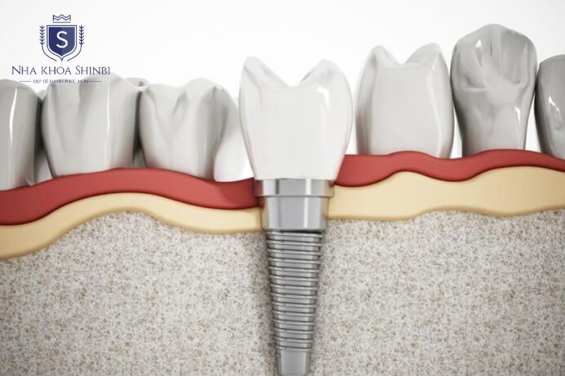 Trồng implant răng hàm đạt kết quả tốt khi bệnh nhân đáp ứng đủ 4 điều kiện