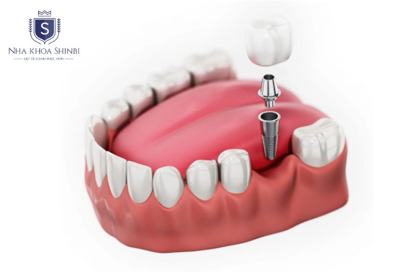 Trồng implant răng hàm đòi hỏi đánh giá giải phẫu chuyên biệt