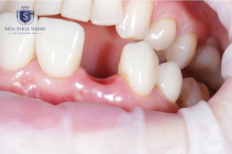 Trồng implant sớm sau khi mất răng giúp tránh hoàn toàn chi phí ghép xương