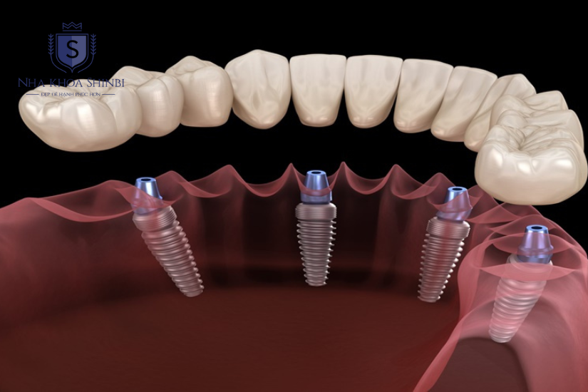 Implant All on 4 là kỹ thuật cấy 4 trụ titanium vào xương hàm