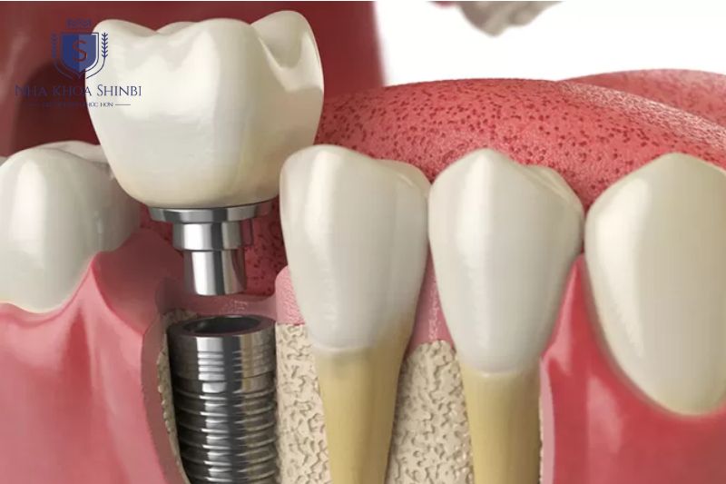Trồng răng implant có chi phí cao hơn các phương pháp phục hình răng khác