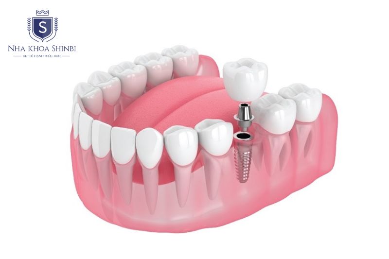 Trồng sớm sau khi mất răng giúp tiết kiệm chi phí ghép xương