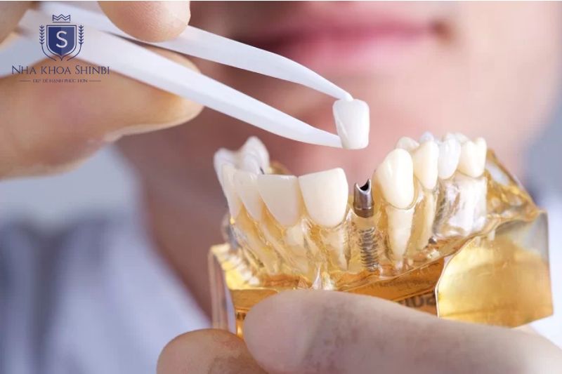 Trụ implant được bảo hành dài hạn tùy theo dòng trụ