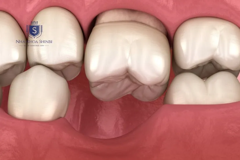 Ảnh hưởng đến sự phát triển tự nhiên của răng và xương Ảnh hưởng đến sự phát triển tự nhiên của răng và xương