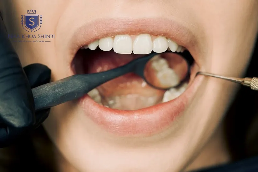Bảng giá bọc răng sứ số 6 mới nhất Bảng giá bọc răng sứ số 6 mới nhất