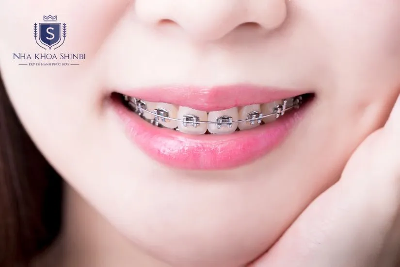 Bảng giá niềng răng sứ thẩm mỹ Bảng giá niềng răng sứ thẩm mỹ