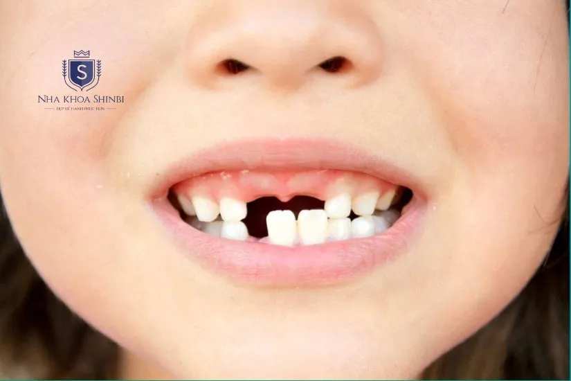 Bao nhiêu tuổi thì trồng răng implant được cho trẻ em? Bao nhiêu tuổi thì trồng răng implant được cho trẻ em?