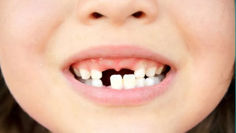 Bao nhiêu tuổi thì trồng răng Implant được đối với trẻ em?