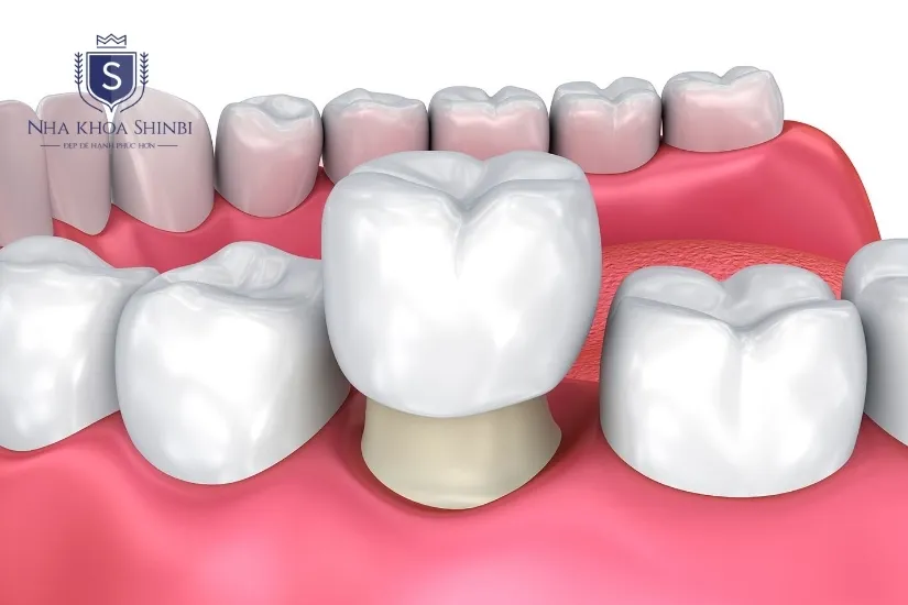 Bọc răng sứ Đức là gì? Bọc răng sứ Đức là gì?