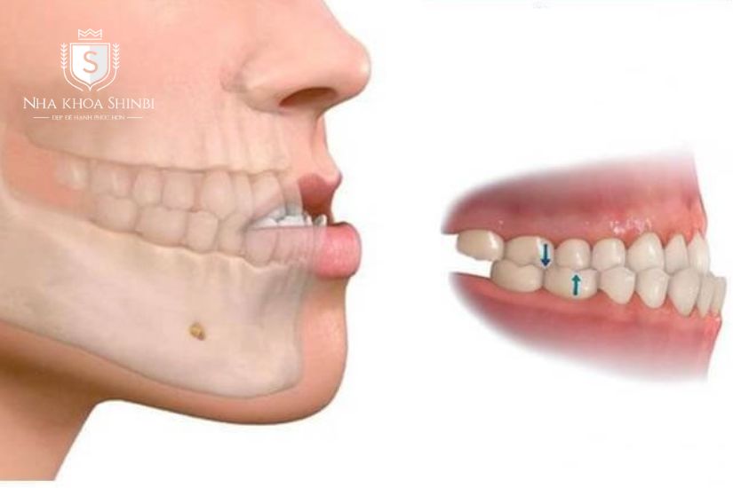 bọc răng sứ khớp cắn ngược bọc răng sứ khớp cắn ngược