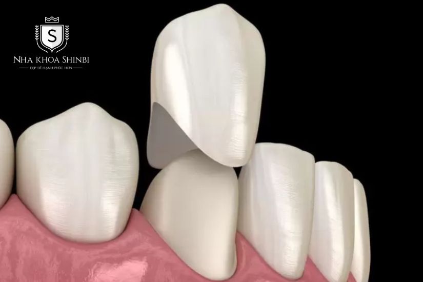 bọc răng sứ khớp cắn ngược bọc răng sứ khớp cắn ngược