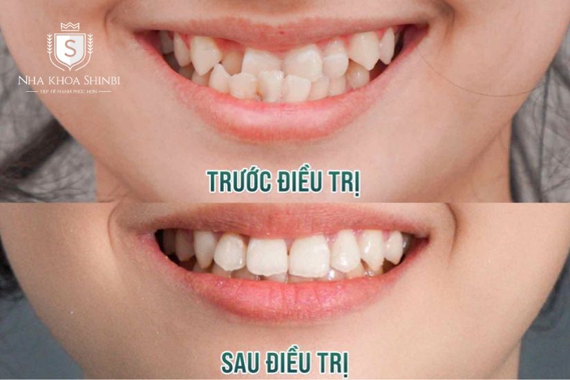 bọc răng sứ khớp cắn ngược
