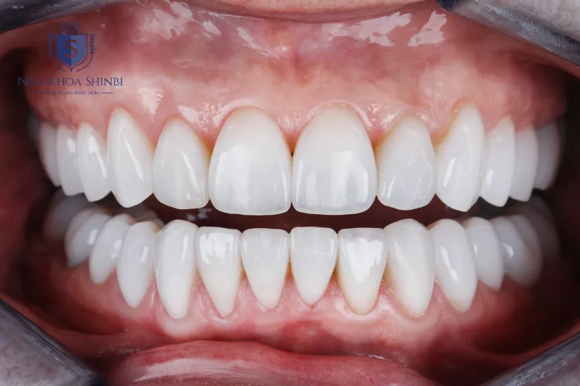 Bọc răng sứ Titan giá bao nhiêu?