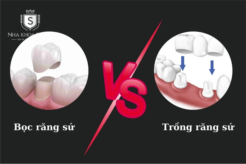 Nên bọc răng sứ hay trồng răng sứ hiệu quả nhất?