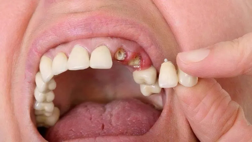 Chỉ còn chân răng bọc sứ được không? Cách làm tối ưu nhất?