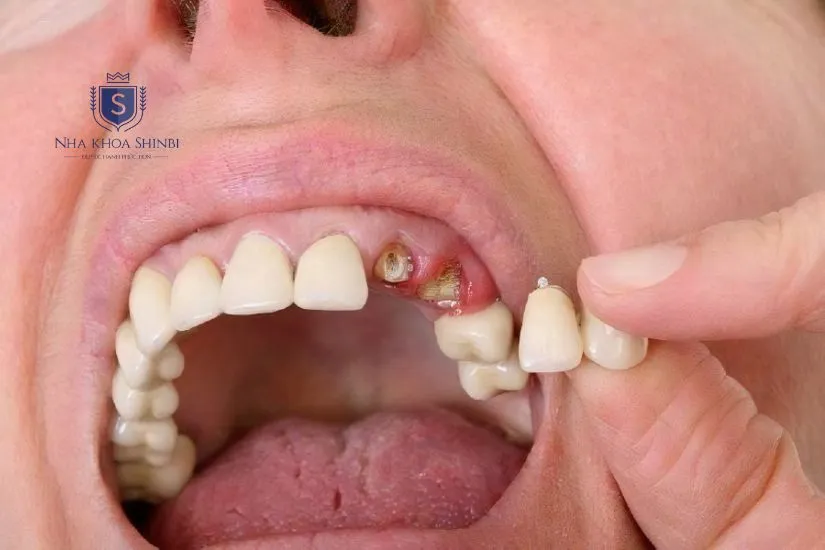 Chỉ còn chân răng bọc sứ được không? Chỉ còn chân răng bọc sứ được không?